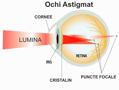 cu astigmatism, vederea se deteriorează)