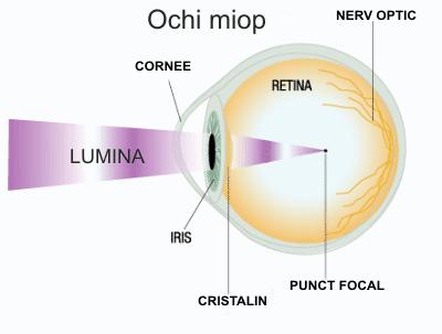 miopia ochiului